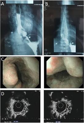 Case report: Simultaneous resections of pulmonary segment and an esophageal leiomyoma during spontaneous ventilation video-assisted thoracoscopic surgery